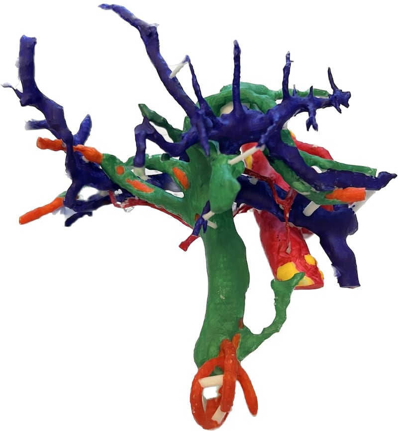 A 3D printed model of a liver used for surgeons to plan complex cancer surgery