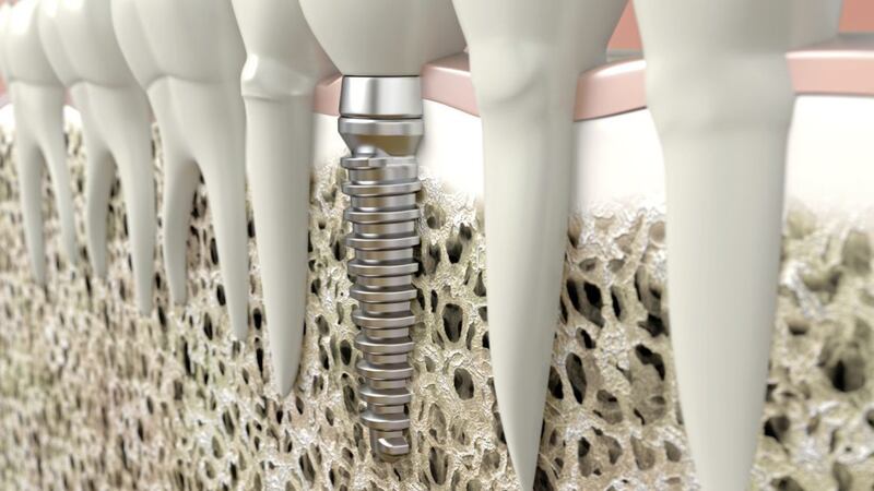 A computer generated image of a dental implant, showing the titanium implant inserted through the gum into the bone 