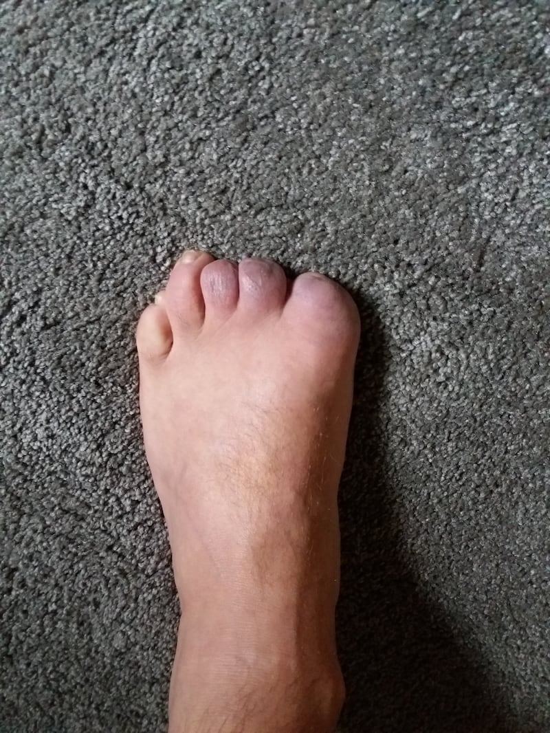 One of Nick Griffiths' feet after the former Marine lost toes to frostbite