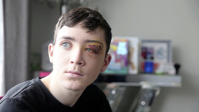 Kyle McPhilips from west Belfast who sustained serious injuries to face when he was attacked outside McDonalds in Castle Place, Belfast. Picture by Mal McCann 