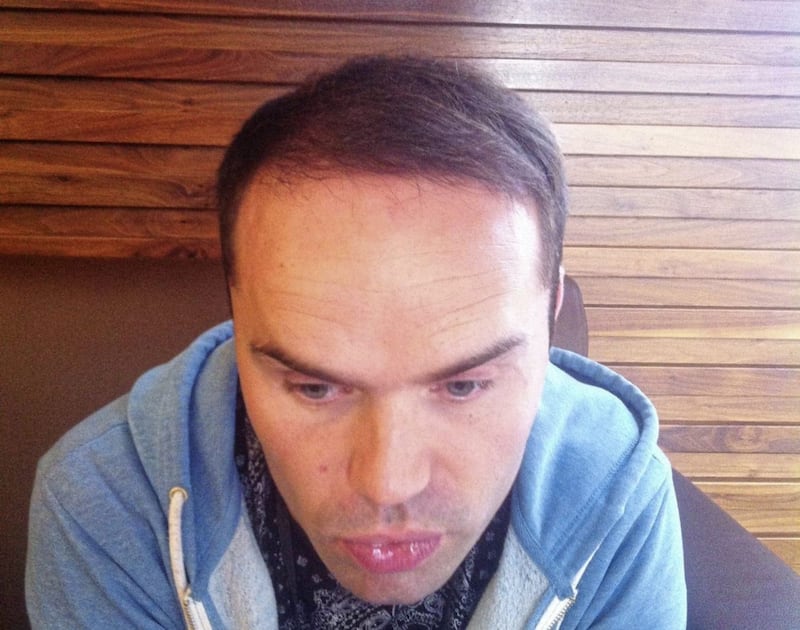Marty Pilkiewicz pictured prior to his hair transplant 