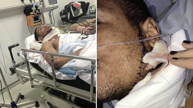 Caoimhin Hynes was stabbed in the face outside a fast-food outlet following a night out in Belfast 