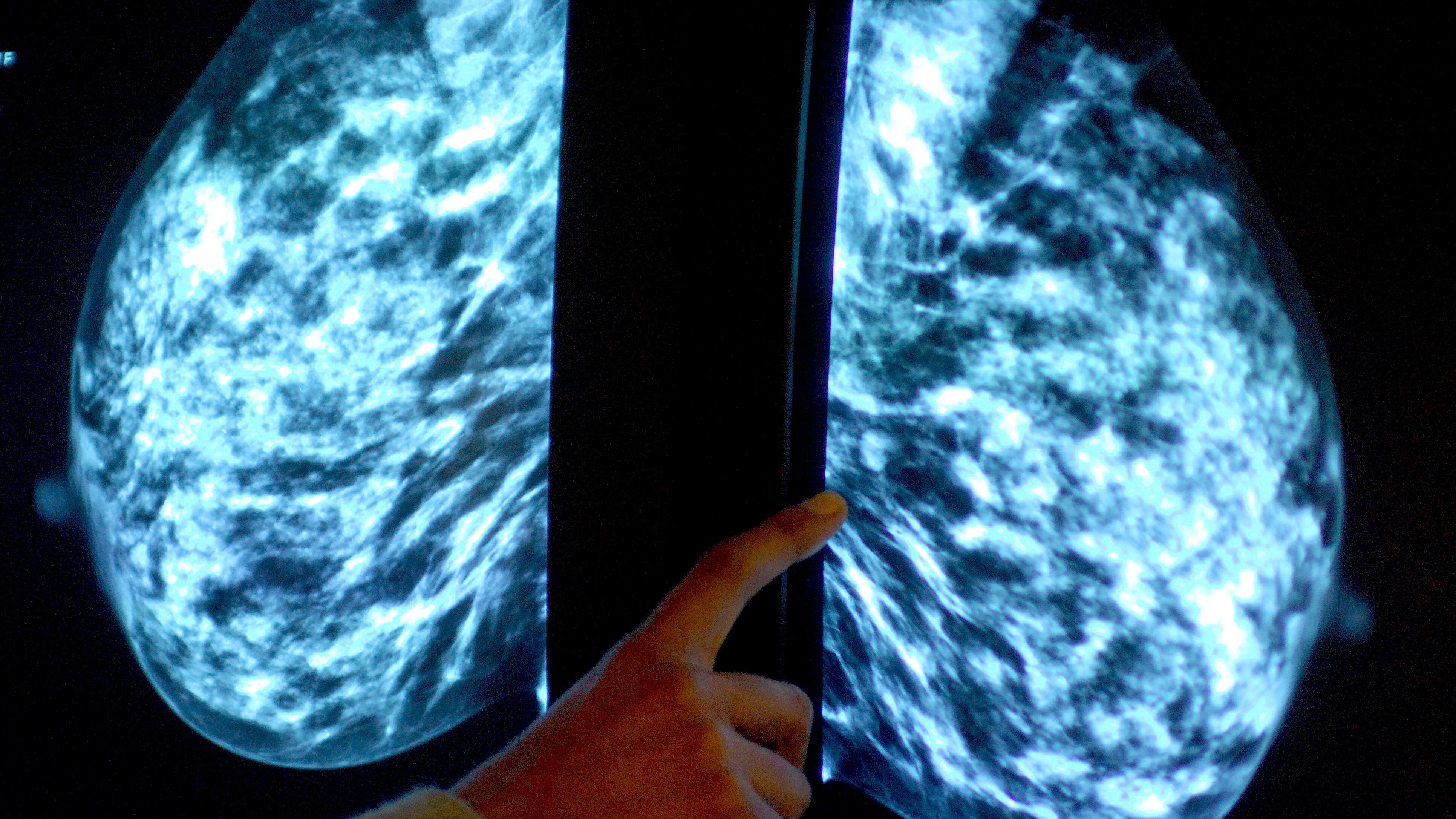 The tests provide information on the genetic makeup of breast cancer tumours