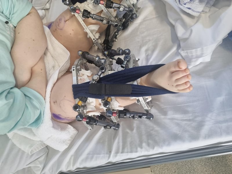 Maria's legs post-operation
