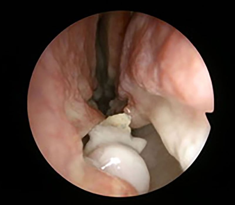 Tooth found in man's nostril