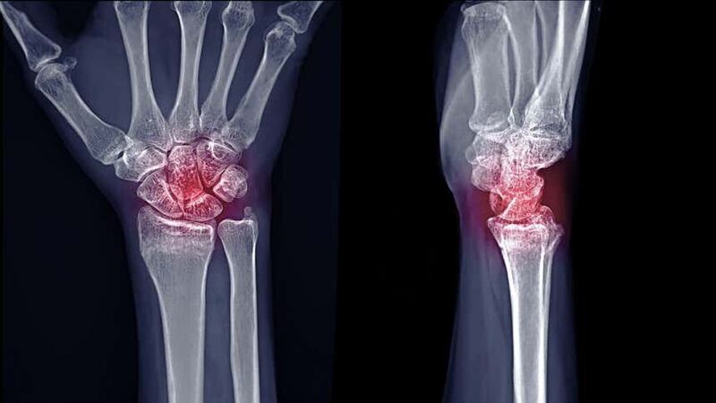 Opioids are sometimes prescribed for pain relief from rheumatoid arthritis in the short-term (Samunella/Alamy/PA)