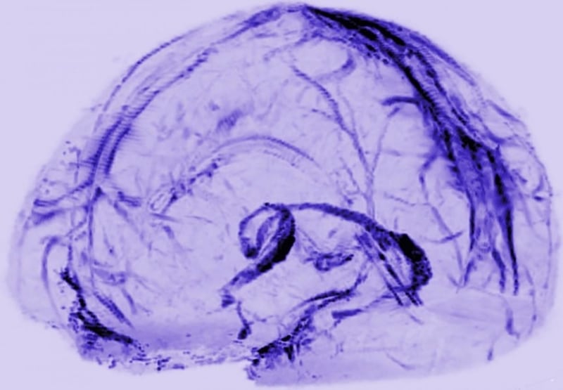 Human lymphatic vessels shown from brain scan (Reich Lab/NIH/NINDS)