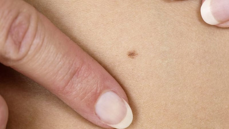 The vast majority of moles are benign but some have the potential to turn into melanoma 