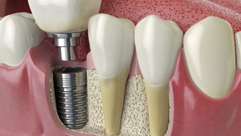 How dental implants are designed to fill gaps 