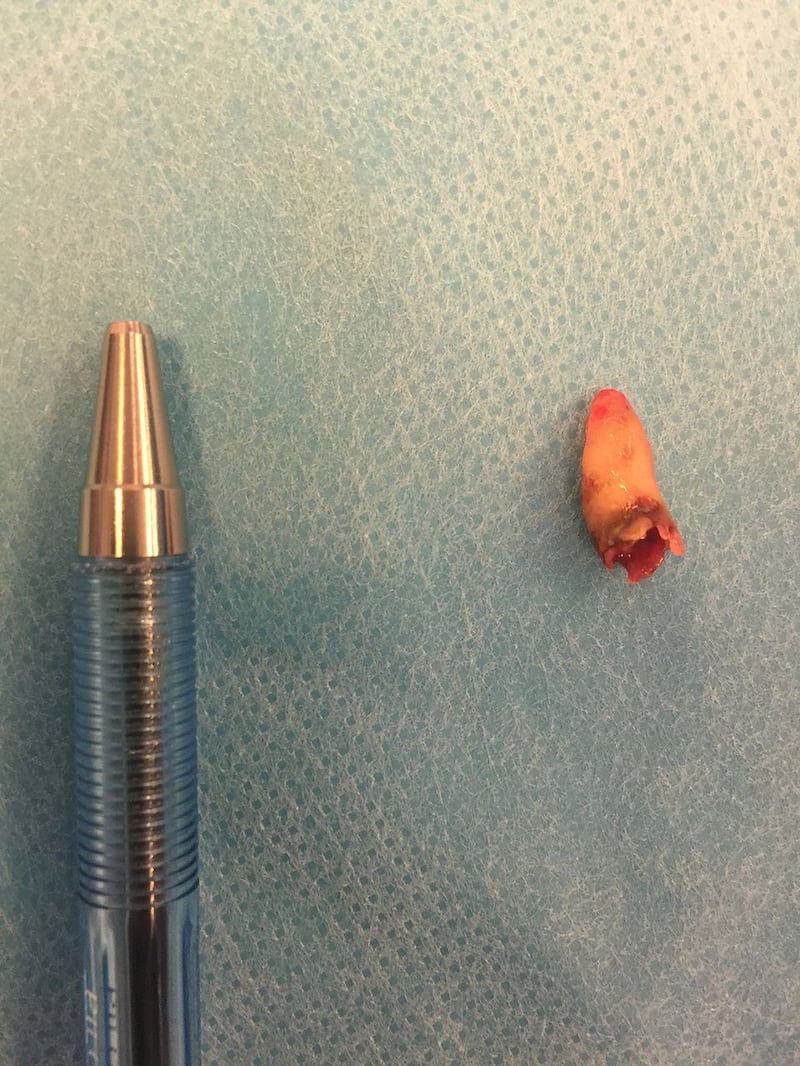 Tooth removed from man's nostril