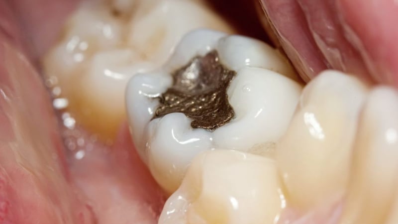 Amalgam fillings like this are being phased out in favour of those made from a safer white composite material 