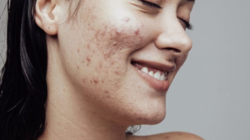 Acne affects almost everyone at some point in their lives 