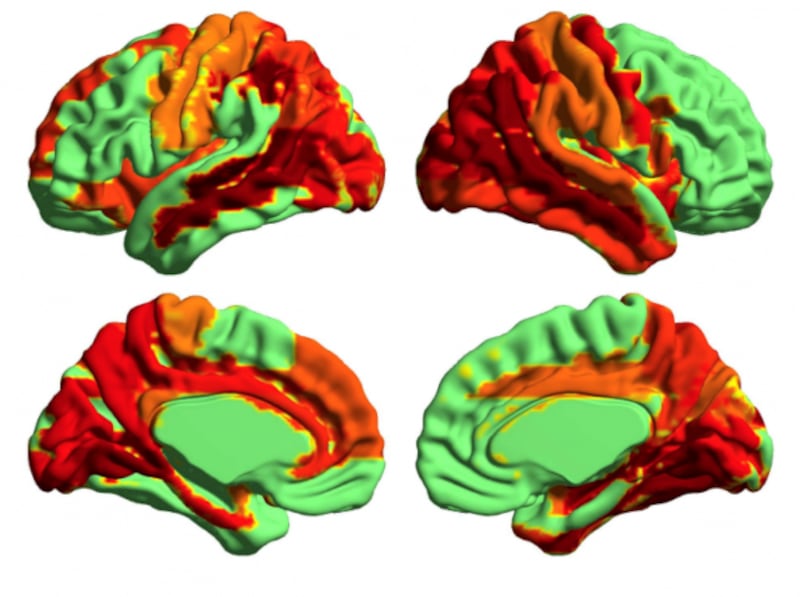 Image created using brain imaging technology, showing changes in neural signal diversity while under the influence of LSD