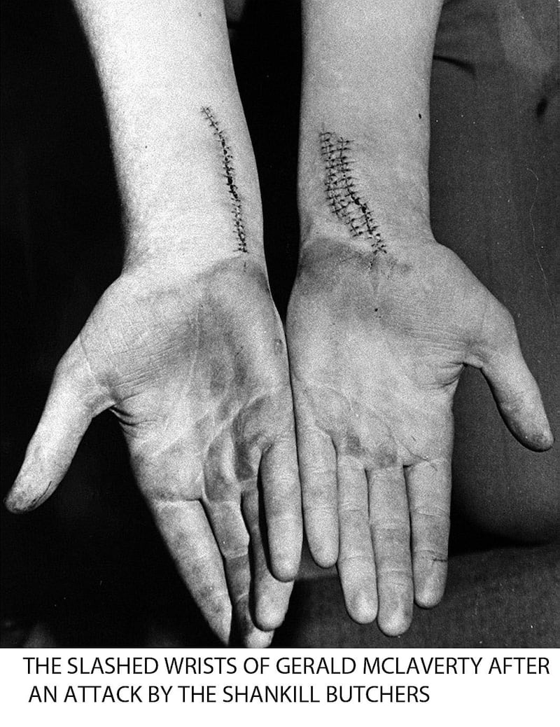 &nbsp;The slashed wrists of Gerard McLaverty who survived an attack. Picture by Pacemaker