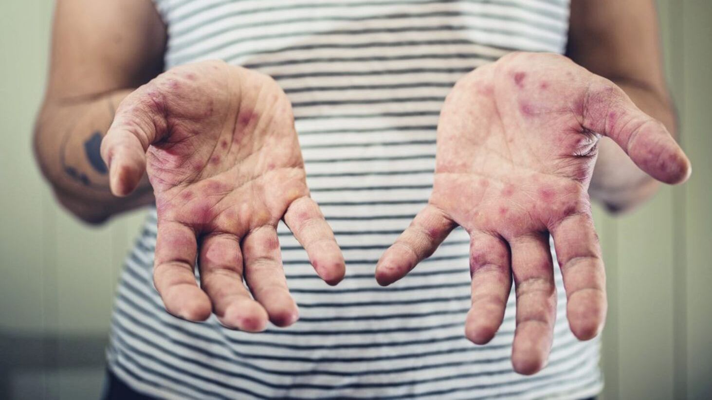 A generic photo of a young man with a measles rash on his hands. See PA Feature HEALTH Measles. Picture credit should read: PA Photo/thinkstockphotos. WARNING: This picture must only be used to accompany PA Feature HEALTH Measles.  