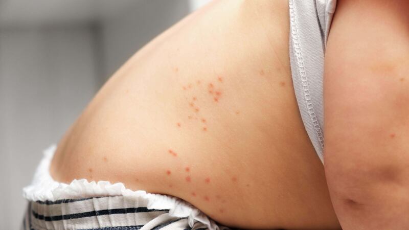 The chickenpox vaccine will help prevent cases of illness, the JCVI said (Alamy/PA)