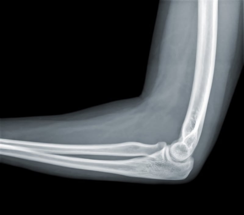 X-ray arm and elbow.