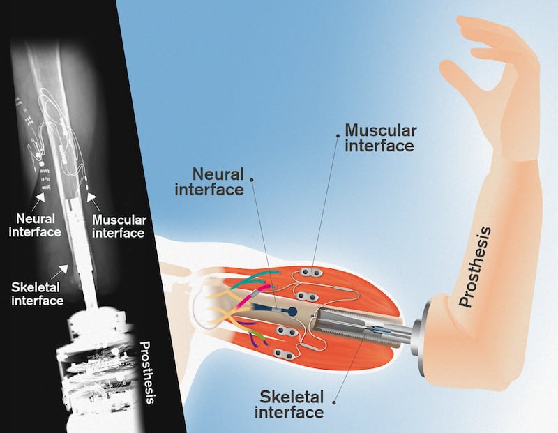 The neuromusculoskeletal prosthesis has a direct connection to a person's nerves, muscles and skeleton