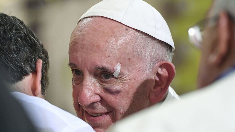 A bruised Pope Francis smiles during his visit to the Sanctuary of St. Peter Claver, in Cartagena, Colombia, Sunday, Sept. 10, 2017&nbsp;