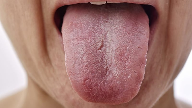 A burning tongue sensation is usually caused by acid reflux or allergies 