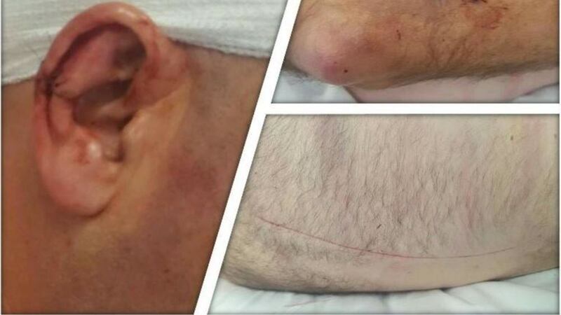 Injuries caused to a man in an attack in Craigavon on Sunday. Picture from PSNI Craigavon 