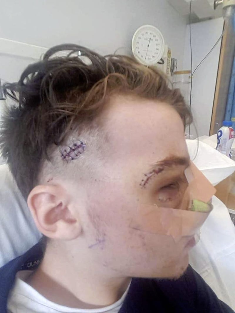 Jason Tuite, from Dundalk, who suffered a catalogue of facial injuries when he was attacked outside a Belfast Vital gig on Boucher Road on August 26. The 16-year-old has underwent surgery in Dublin and two metal plates have been permanently inserted in his face. 