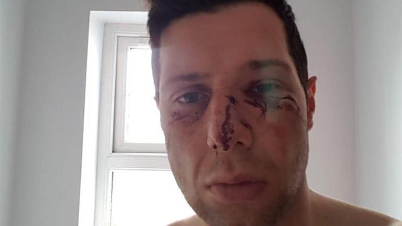&nbsp;Sean Cavanagh suffered a &quot;bad concussion, broken nose and severe facial injuries&quot; in the game between Moy and Edendork