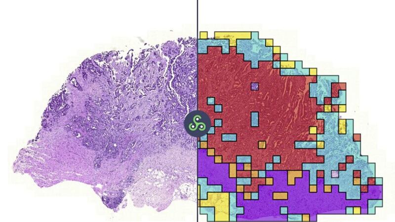 Image shows AI deep learning mapping tumour content on a colorectal cancer digital pathology slide 