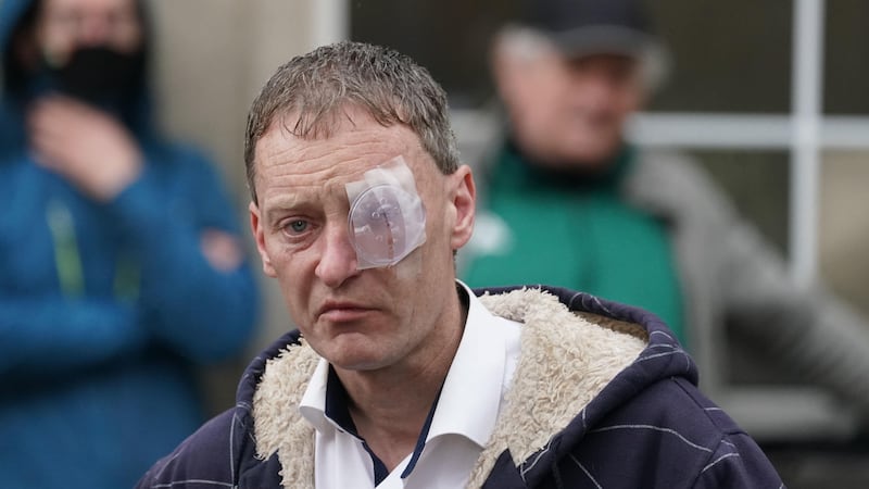 Anthony Burke lost an eye in the attack by Yousef Palani (PA)