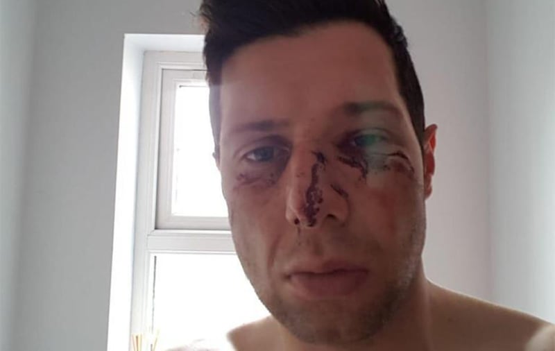 &nbsp;Sean Cavanagh suffered a &quot;bad concussion, broken nose and severe facial injuries&quot; in the game between Moy and Edendork