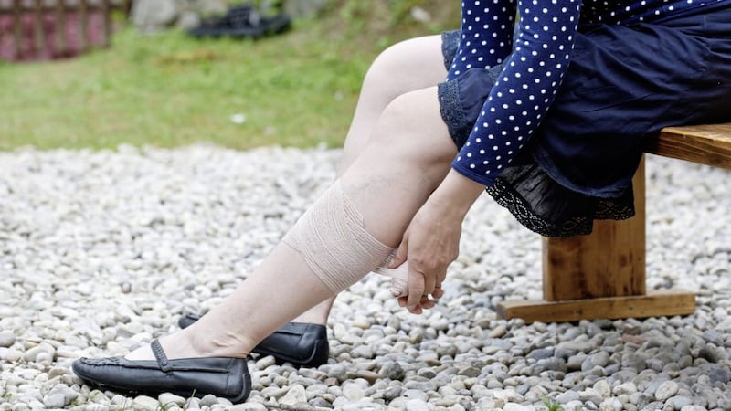 A woman with painful varicose veins on her legs applies a compression bandage 