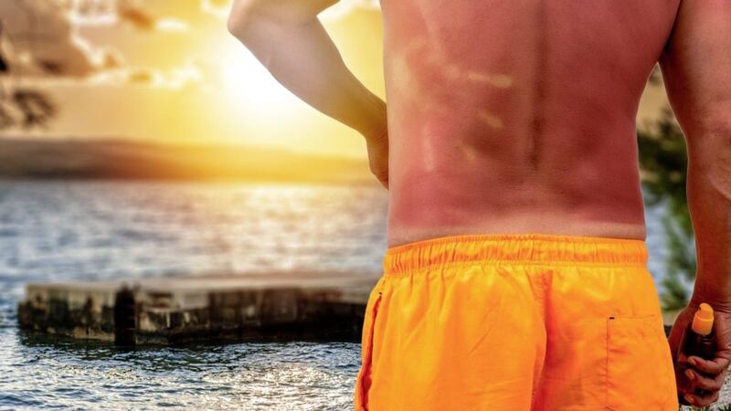 There has been an increase in the number of people going to hospital with sunburn 