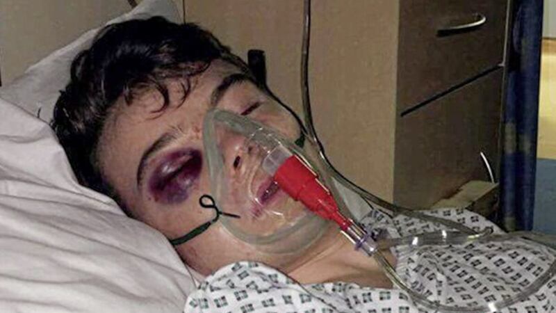 Jason Tuite (16) suffered a catalogue of injuries and may lose the sight in one eye after being attacked following a concert in Belfast 
