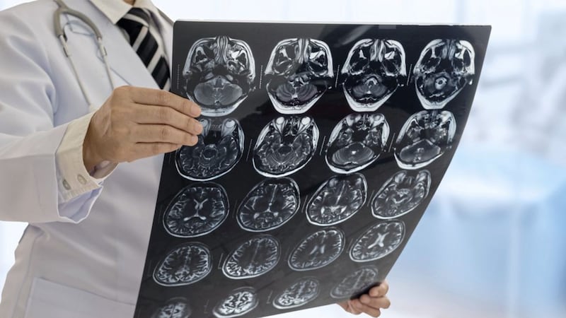 Scientists from have shown that brain clots of stroke patients contain DNA from oral bacteria 