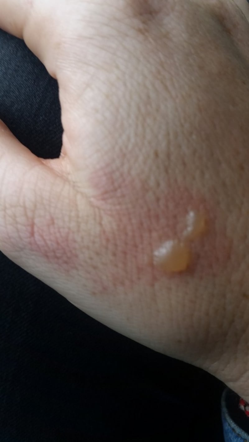 The burn on her hand
