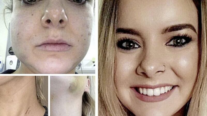 Ciara Hindman (26) and the injuries she suffered following an assault by her former partner. She has said stalking legislation is essential to protect those trying to escape obsessive relationships 