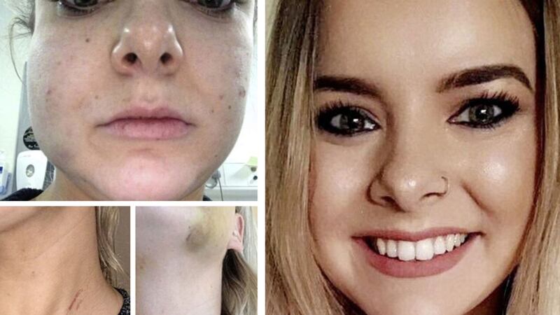 Ciara Hindman and the injuries she suffered following the assault by her former partner James McQuillan&nbsp;