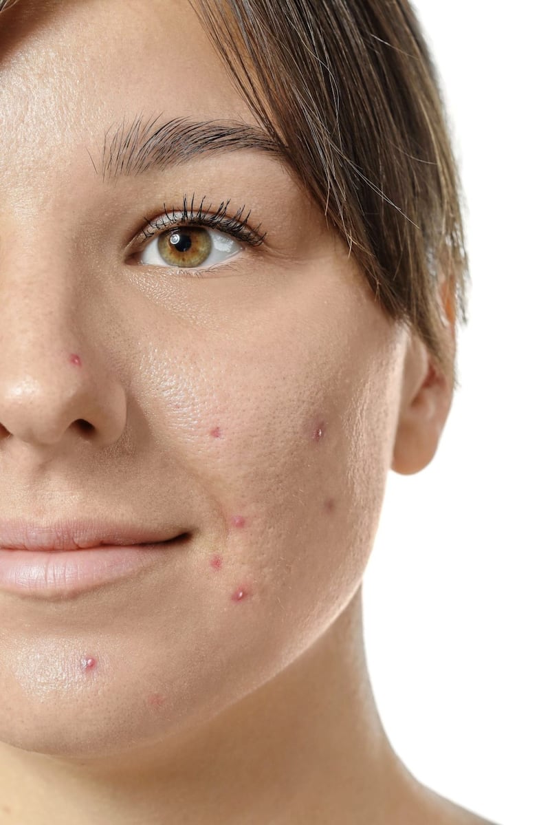 Many women experience acne after giving birth 