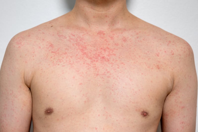 An adult man's chest covered in the red spots of a measles rash