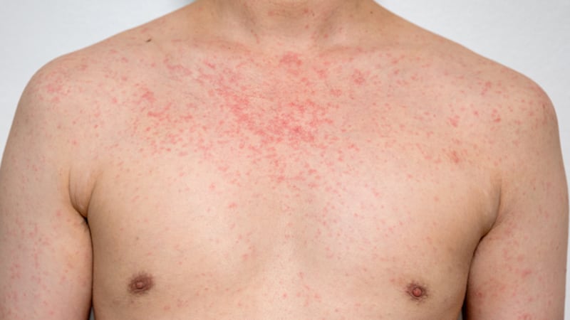 An adult man's chest covered in the red spots of a measles rash