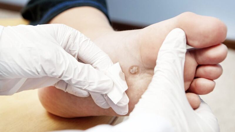 Patch could banish warts 