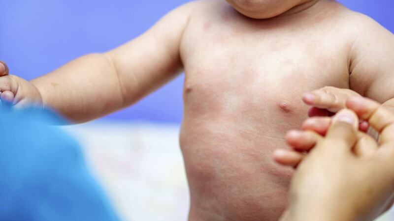 Common skin conditions for very young children include a rash 