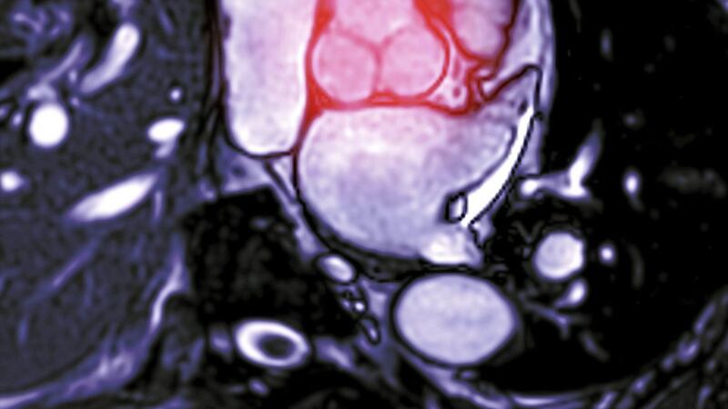 A cardiac MRI image showing an aortic valve &ndash; an MRI imaging technique known as T1 mapping may be able to pick up a type of cancer that affects babies and young children 