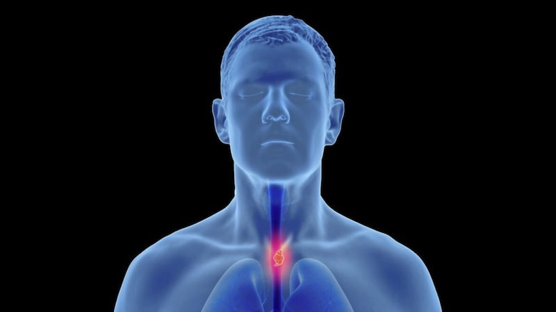 Oesophageal cancer is hard to treat because most people don&#39;t respond to chemotherapy. 