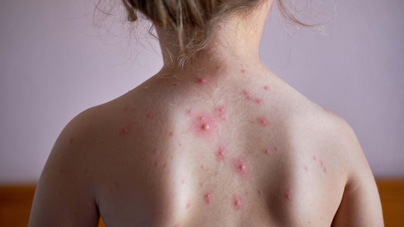 Experts are recommending the chickenpox vaccine for children under 18 months (Alamy/PA)