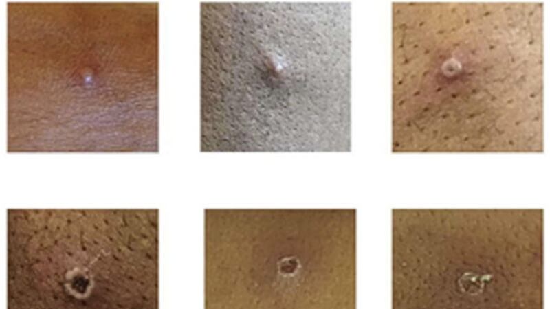 An image released by the UK Health Security Agency showing the stages of monkeypox lesions in those infected with the virus. 