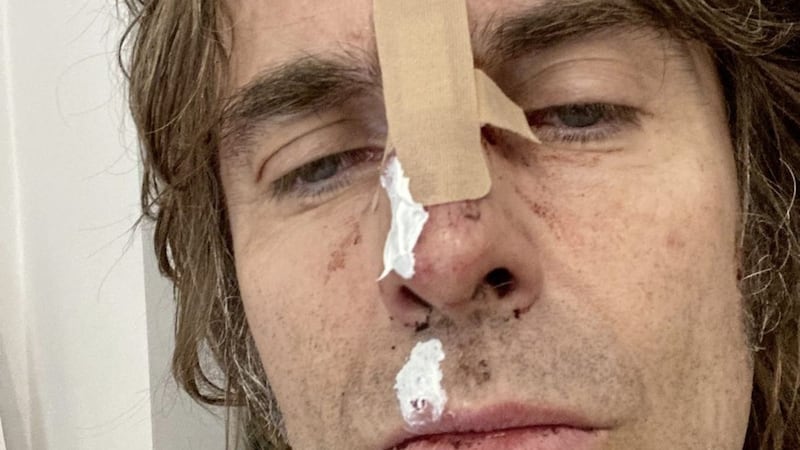 Liam Gallagher shared a photo of his bruised and cut face. Picture by Liam Gallagher/Twitter 