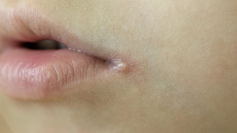 Sores at the corners of their mouth known as angular cheilitis can be a sign that the immune system isn&rsquo;t working ideally 