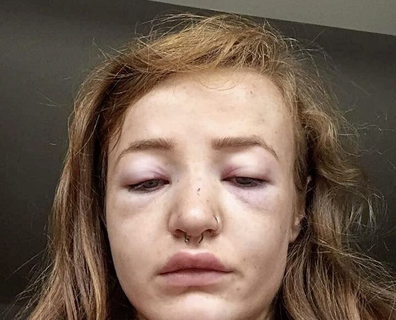 Assault victim, Shanan Reid McDaid&#39;s face was left bruised and swollen following an attack by a man from County Donegal or Northern Ireland.  