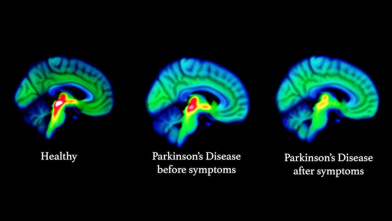 The red and yellow areas shown in brain imaging scans show that serotonin function reduces before movement symptoms develop (KCL/ PA)